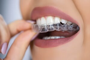 Clear Aligners: Benefits, Treatment Process & Everything You Need to Know